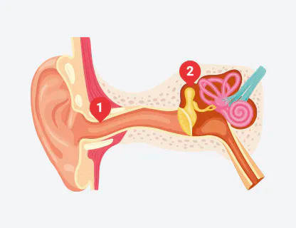 Pérdida Auditiva Conductiva